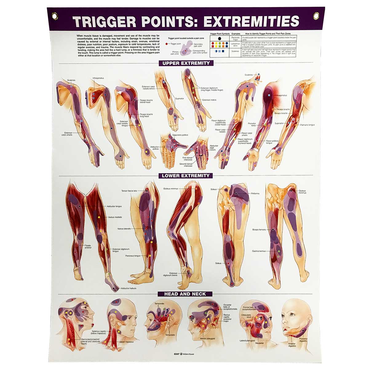 Trigger Points: Extremities Chart